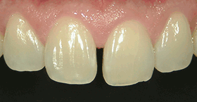 ほんの小さな隙間でも、見た目に大きな影響を及ぼす「すきっ歯」