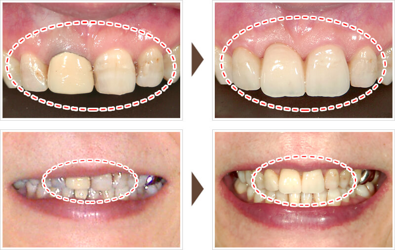 前歯4本の治療